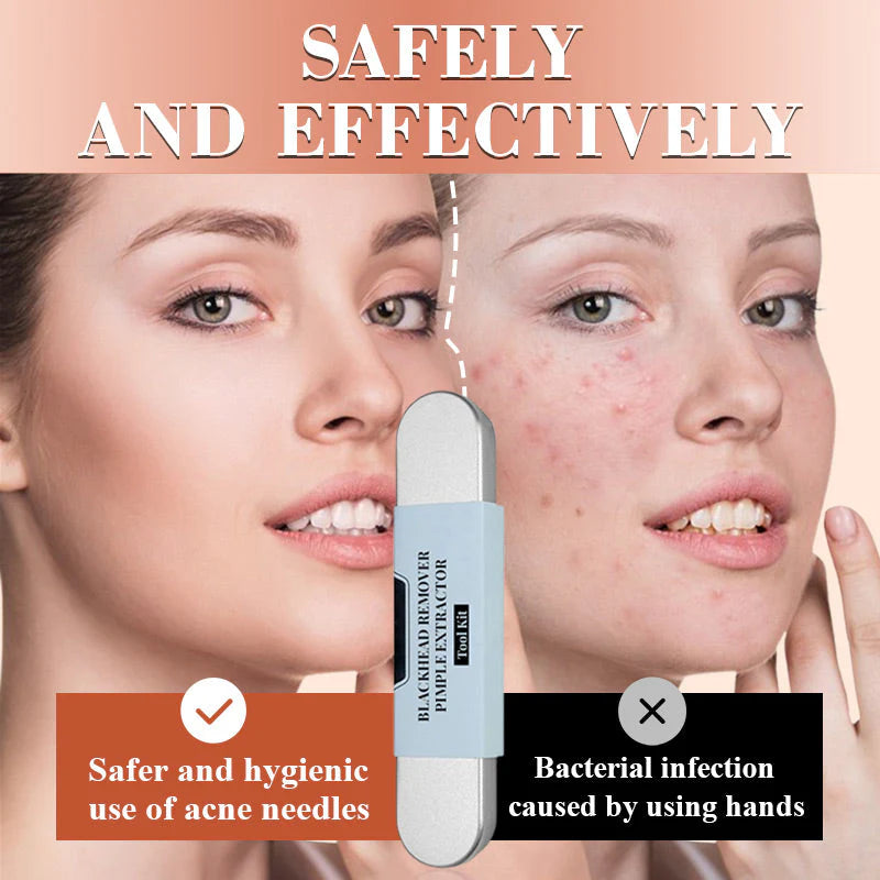 LUXGRIP - Blackhead Remover Kit